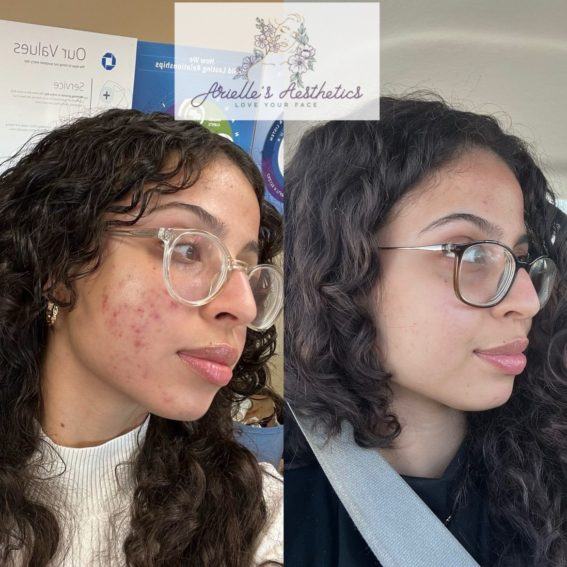 Clearing Acne for Good: Our Holistic Approach to Skin Transformation